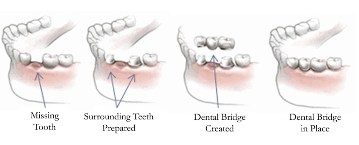 Dental Bridges