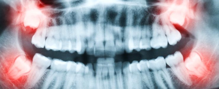 Wisdom Teeth